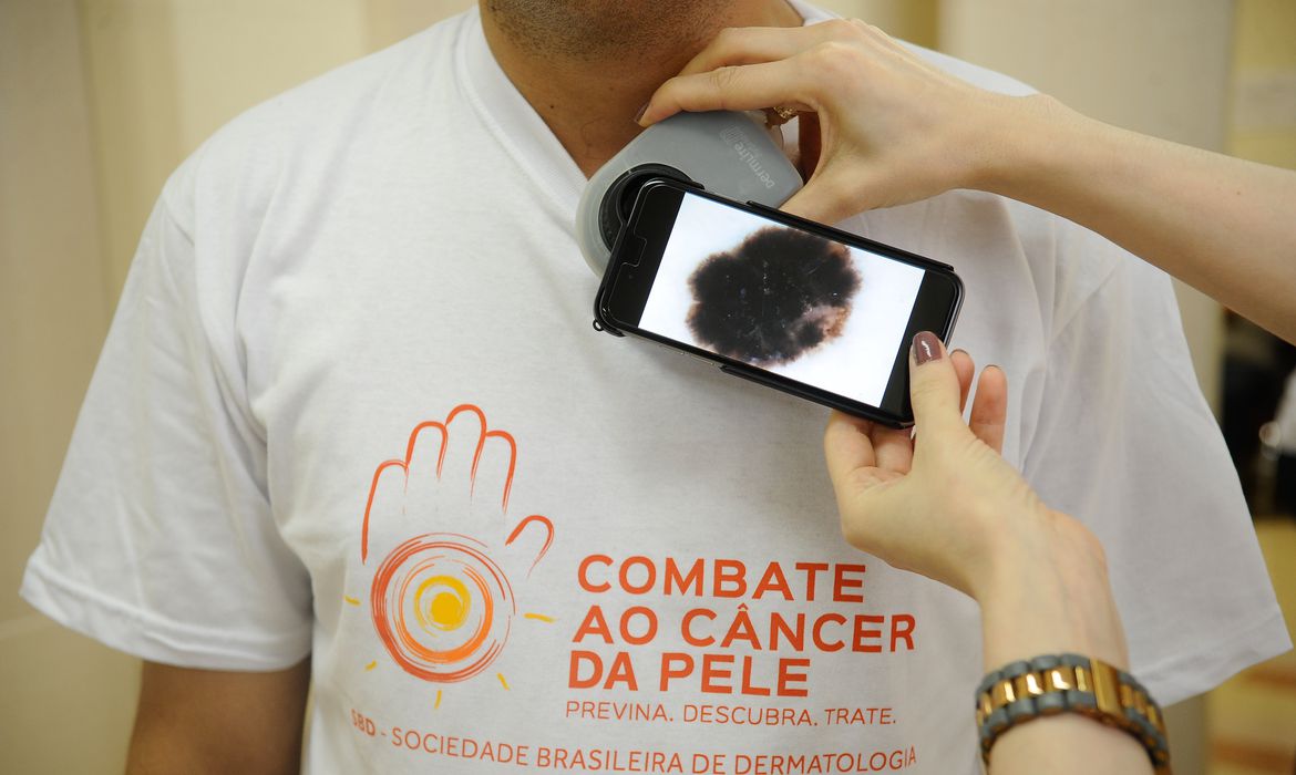 <strong>Saúde fará ação especial de prevenção e combate ao Câncer de Pele</strong>