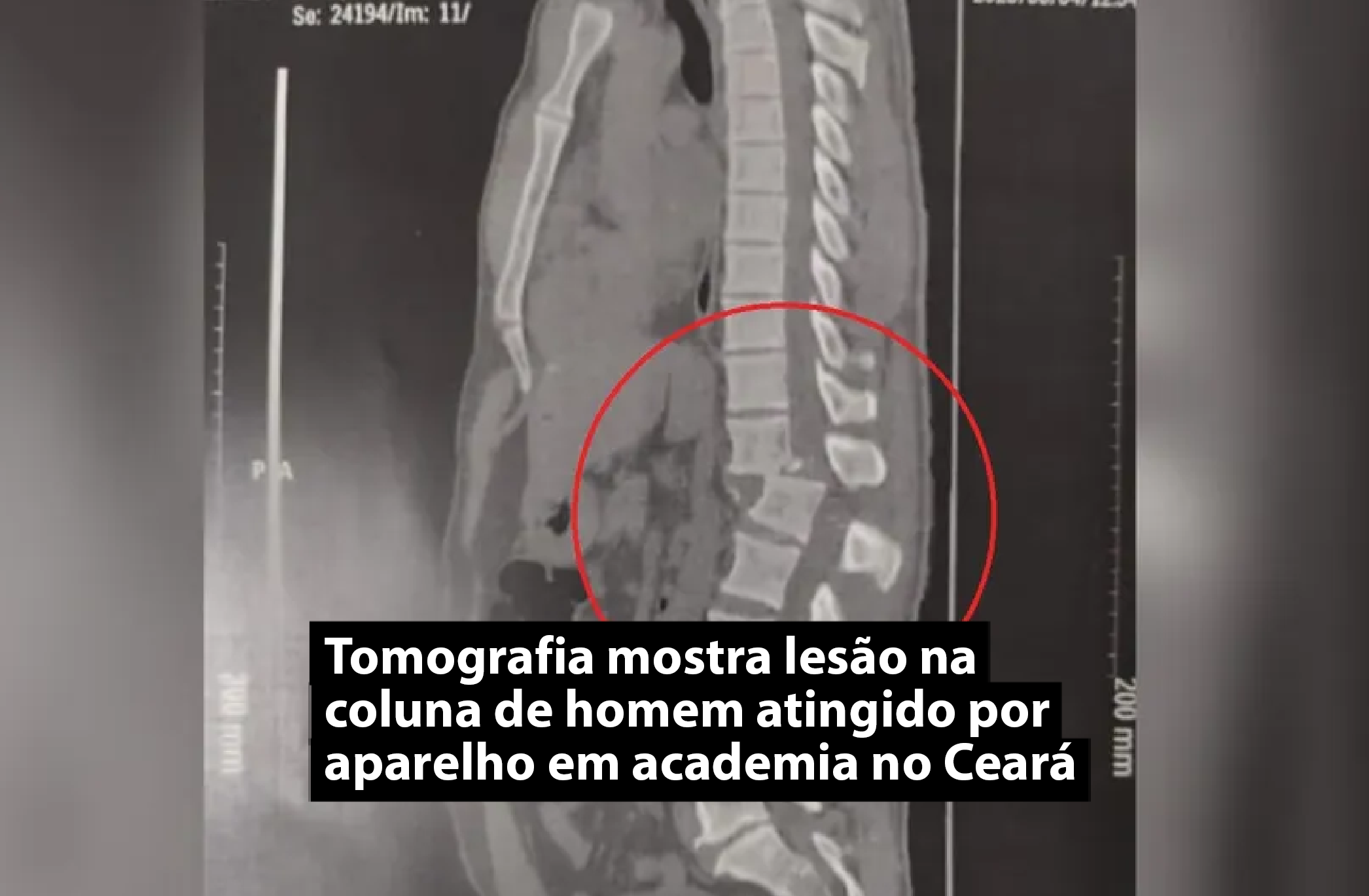 Tomografia mostra lesão na coluna de homem atingido por aparelho em academia no Ceará